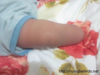 amniotic band syndrome